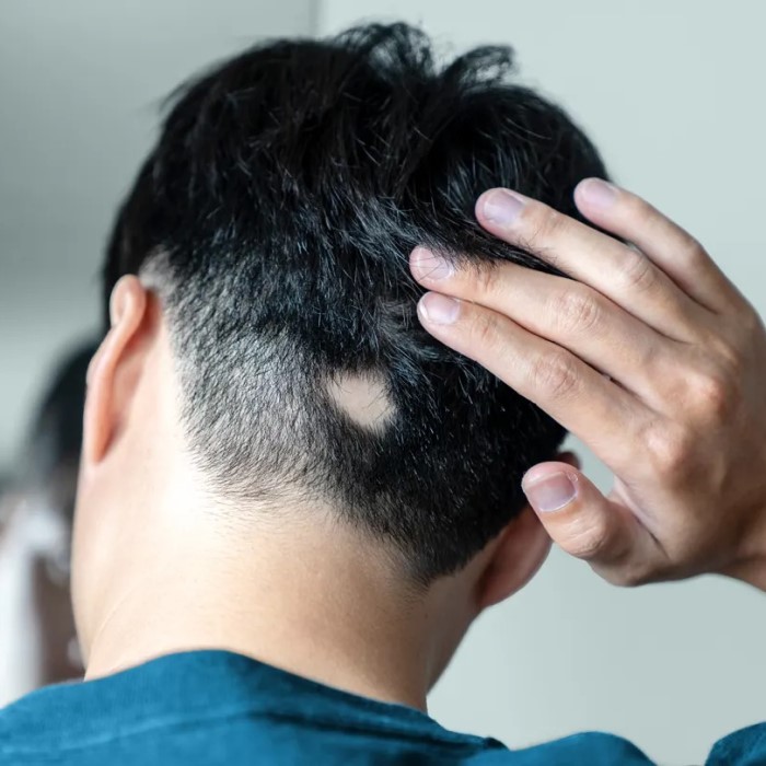 does amlodipine cause hair loss