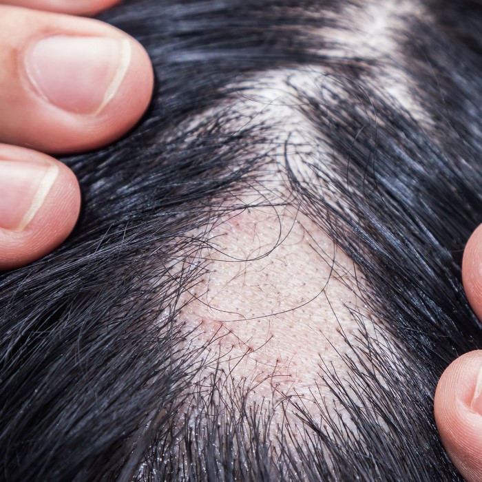 does lupus cause hair loss