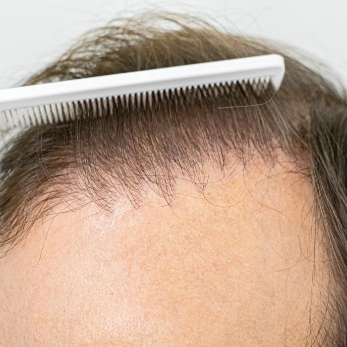 can anesthesia cause hair loss