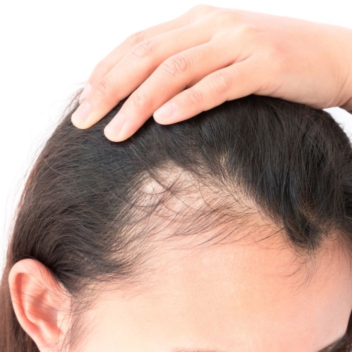 does menopause cause hair loss
