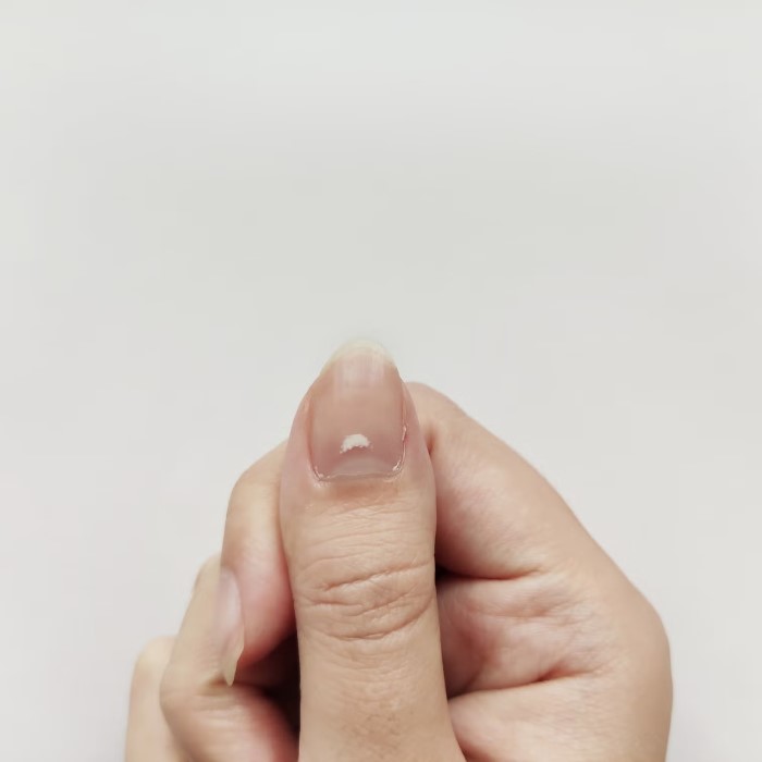 why is there a white spot on my nail