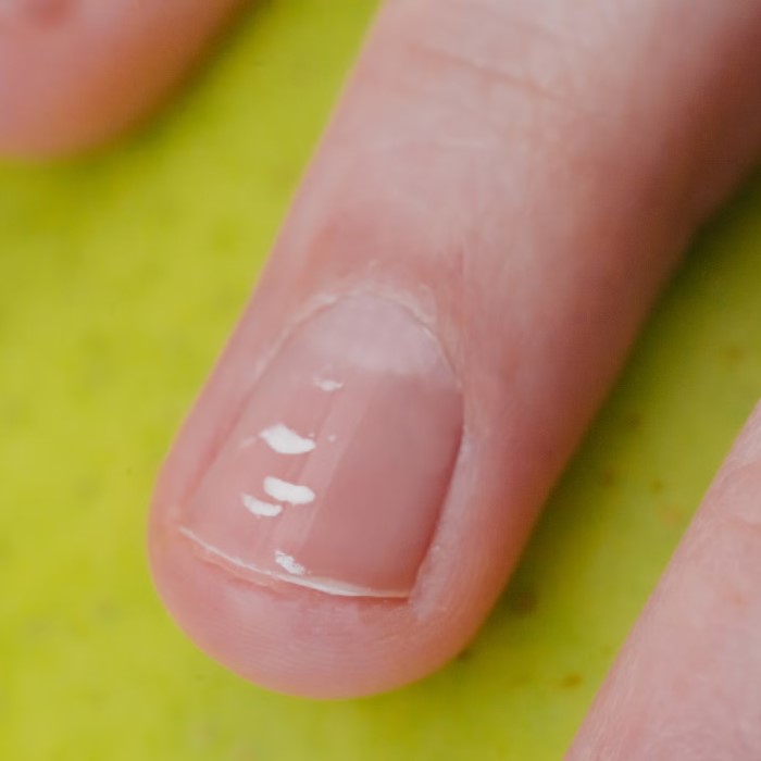 why is there a white spot on my nail