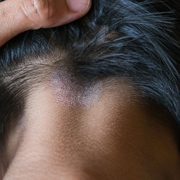can candida cause hair loss