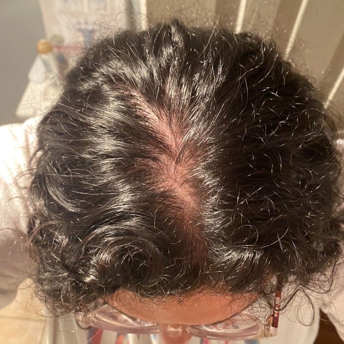 does low b12 cause hair loss