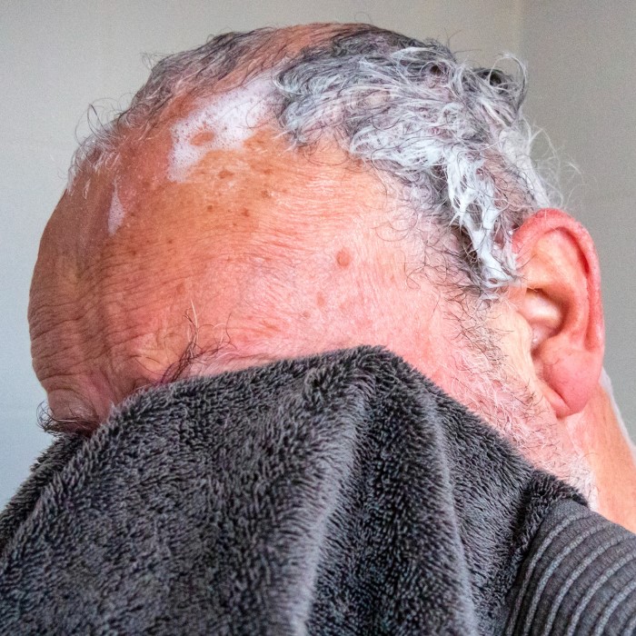 does nizoral cause hair loss