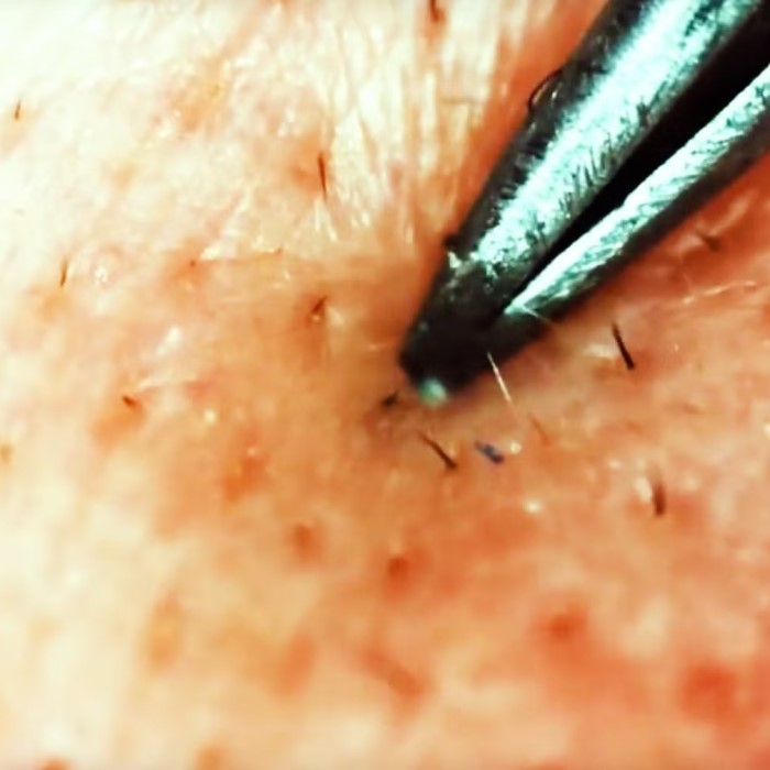 does hair removal cream cause ingrown hairs