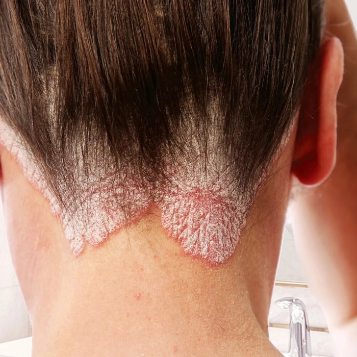 does psoriasis cause hair loss
