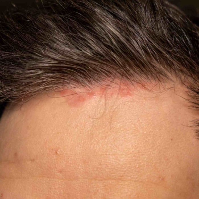does psoriasis cause hair loss
