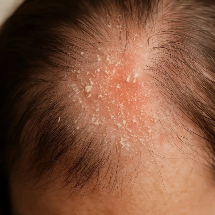 can candida cause hair loss