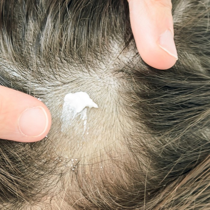 can candida cause hair loss