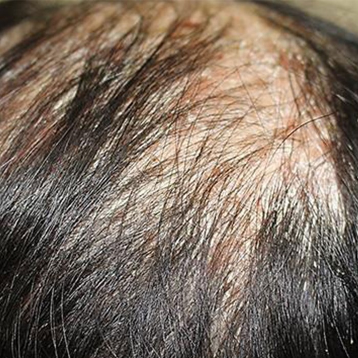 does psoriasis cause hair loss