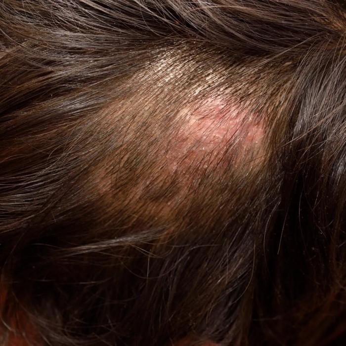 can candida cause hair loss