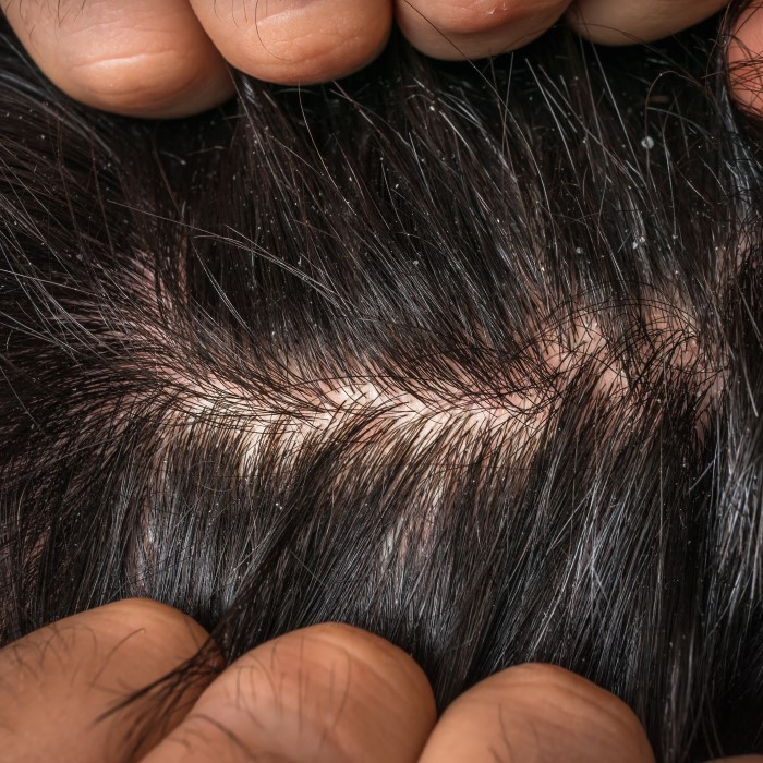 does washing your hair everyday cause hair loss