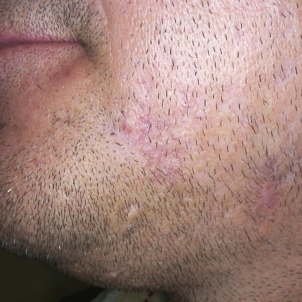 can facial hair cause acne