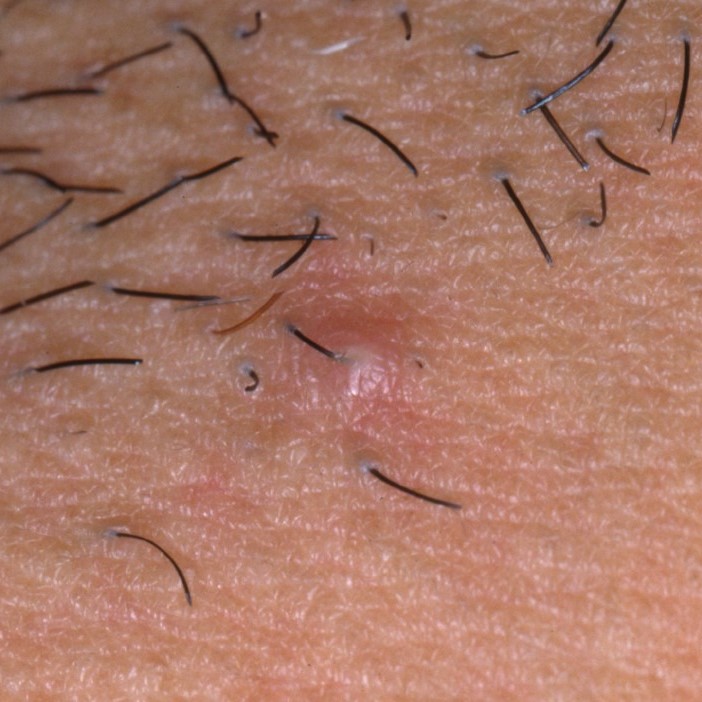 does hair removal cream cause ingrown hairs