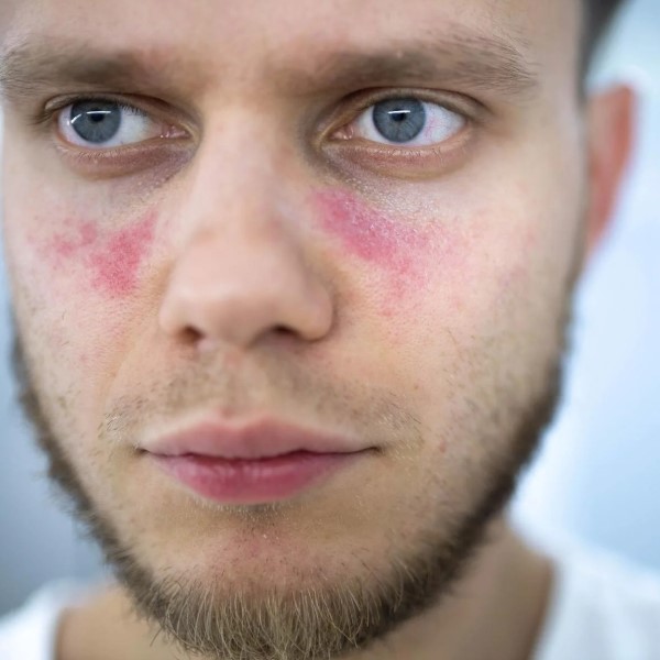 can lupus cause hair loss