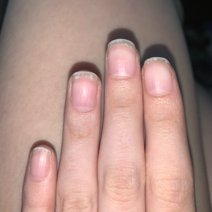 why is there a white spot on my nail