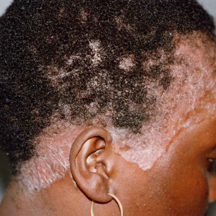 does psoriasis cause hair loss