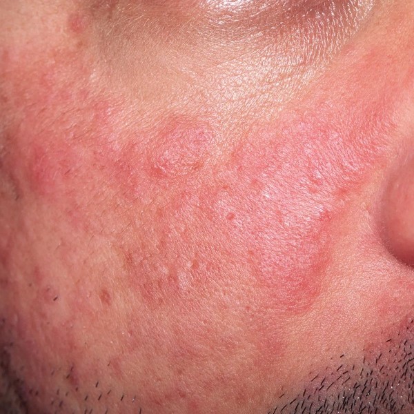 can lupus cause hair loss