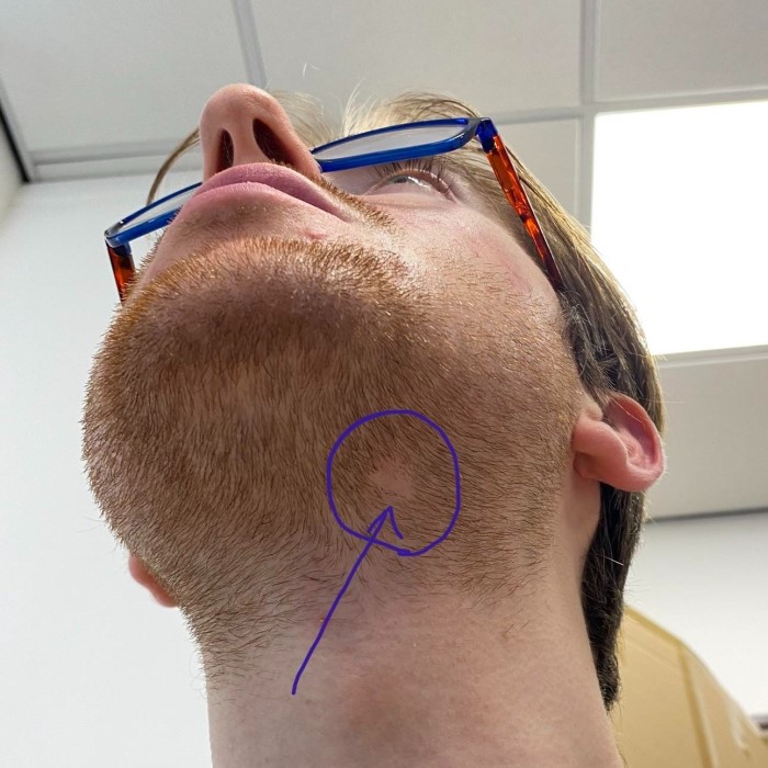 can facial hair cause acne