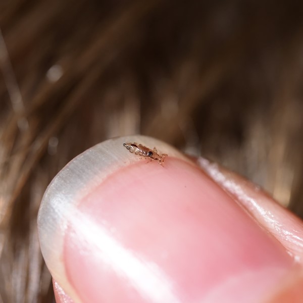 can lice cause hair loss