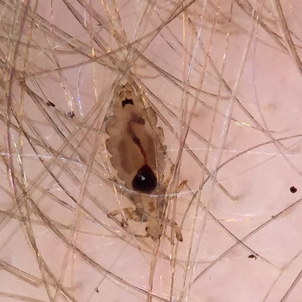 can lice cause hair loss