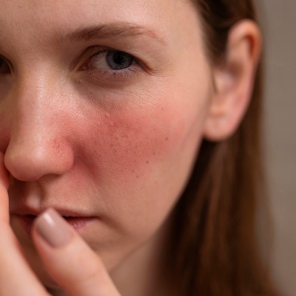 can lupus cause hair loss