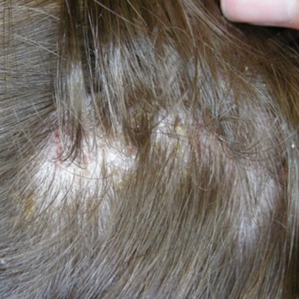 can lice cause hair loss