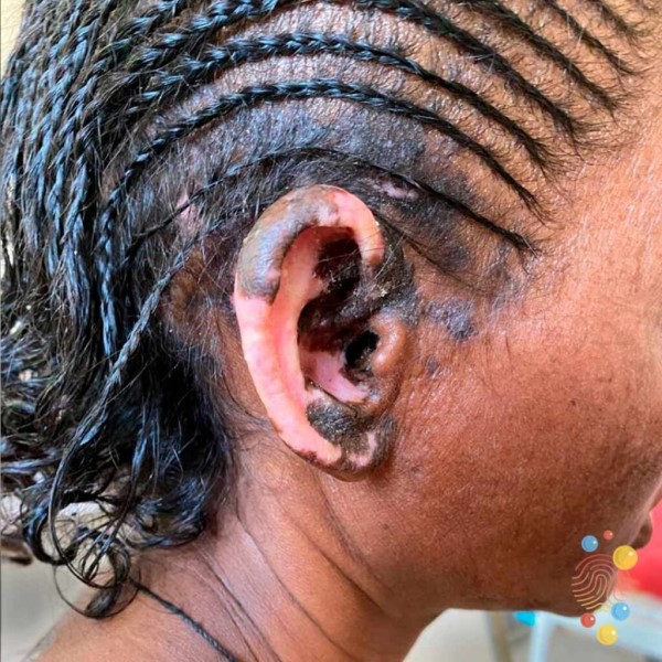 can lupus cause hair loss