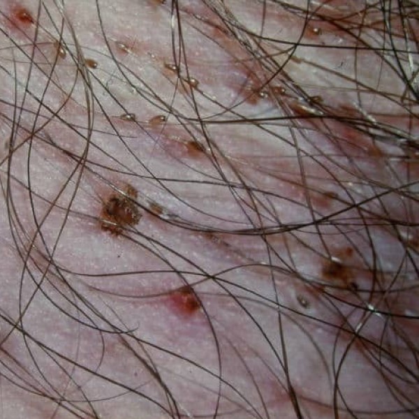can lice cause hair loss