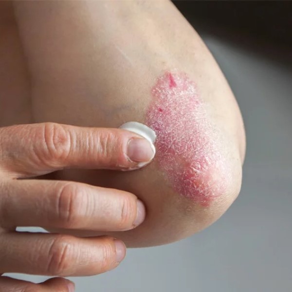 can lupus cause hair loss