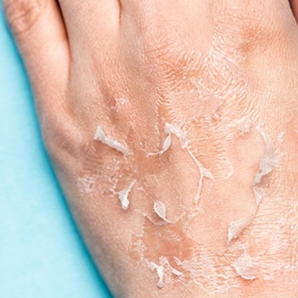 is hyaluronic acid good for dry skin