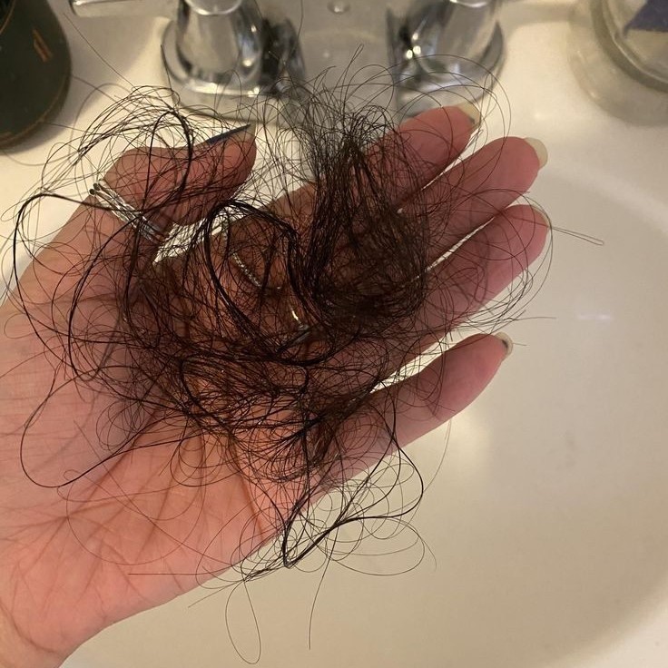 does sertraline cause hair