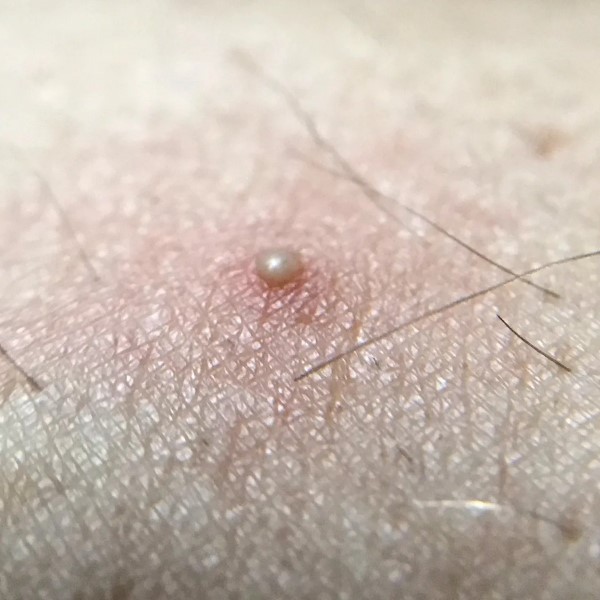how to get rid of ingrown hair