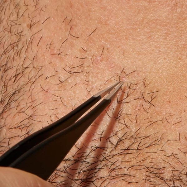 how to get rid of ingrown hair