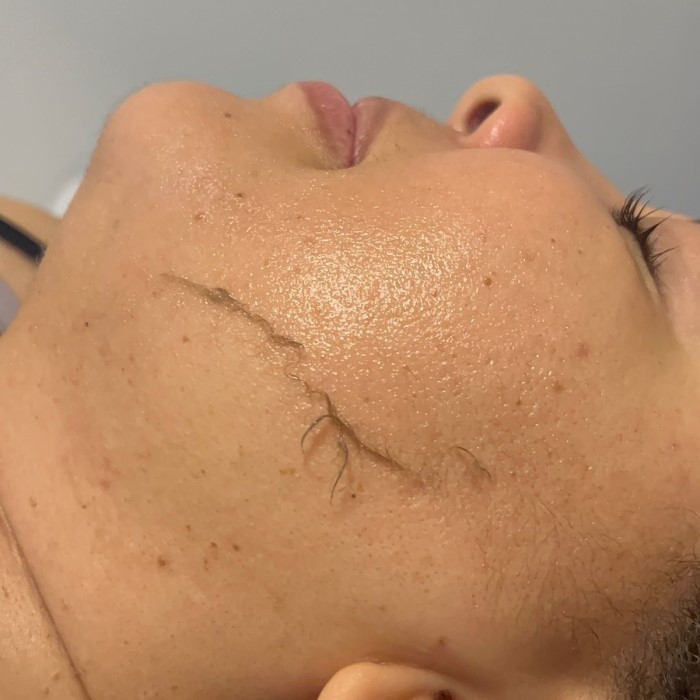 dermaplaning at home