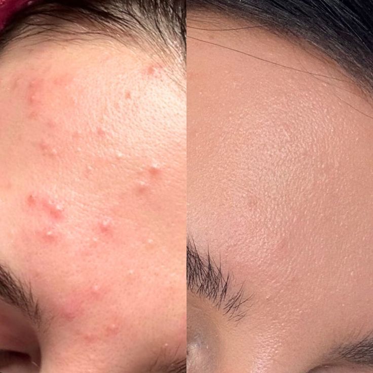 tretinoin before and after