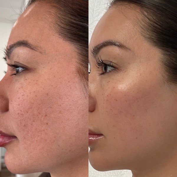 tretinoin before and after